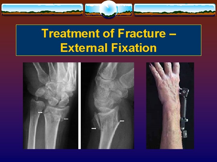 Treatment of Fracture – External Fixation 