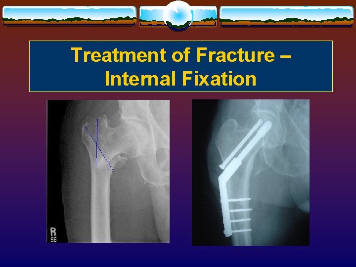 Treatment of Fracture – Internal Fixation 