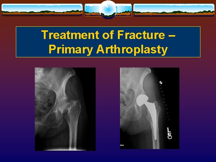 Treatment of Fracture – Primary Arthroplasty 