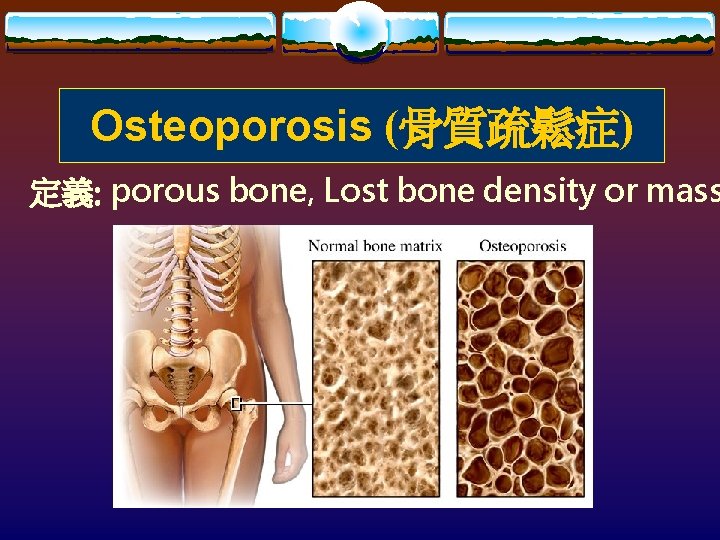 Osteoporosis (骨質疏鬆症) 定義: porous bone, Lost bone density or mass 