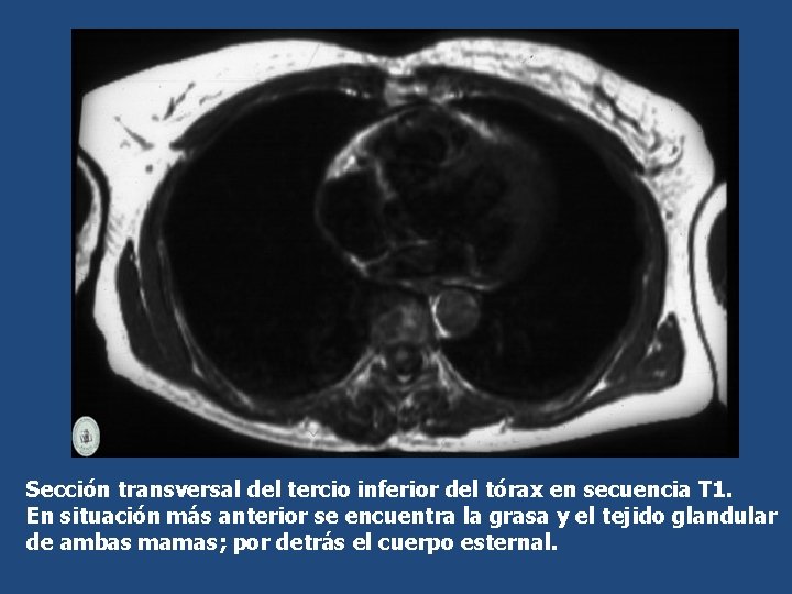 Sección transversal del tercio inferior del tórax en secuencia T 1. En situación más