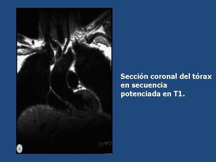 Sección coronal del tórax en secuencia potenciada en T 1. 