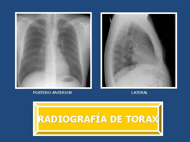 POSTERO-ANTERIOR LATERAL RADIOGRAFÍA DE TORAX 