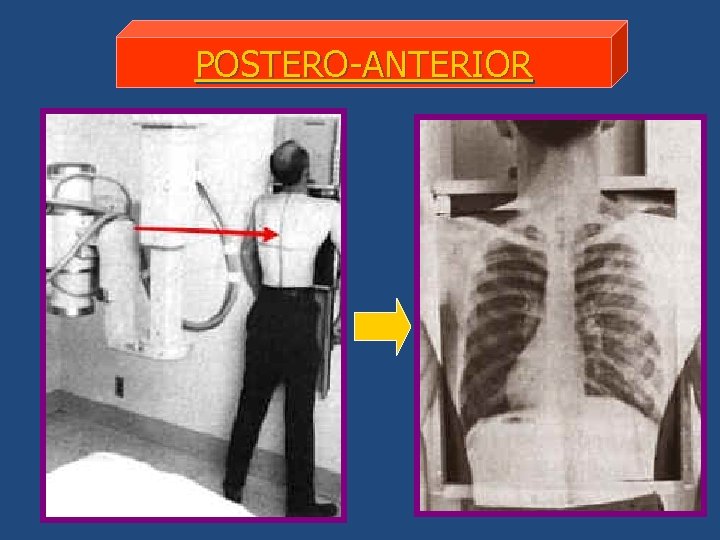 POSTERO-ANTERIOR 