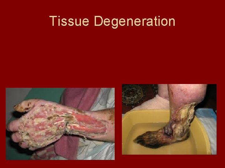 Tissue Degeneration 