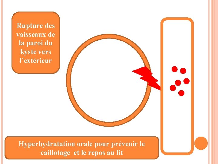 Rupture des vaisseaux de la paroi du kyste vers l’extérieur Hyperhydratation orale pour prévenir