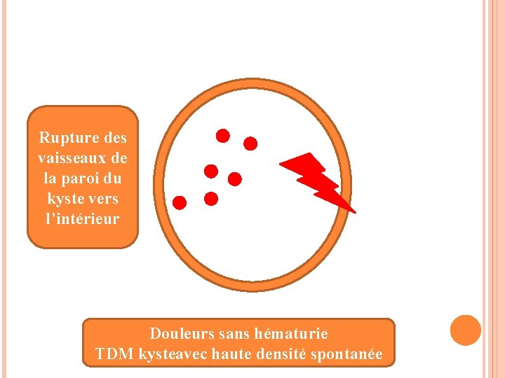 Rupture des vaisseaux de la paroi du kyste vers l’intérieur Douleurs sans hématurie TDM