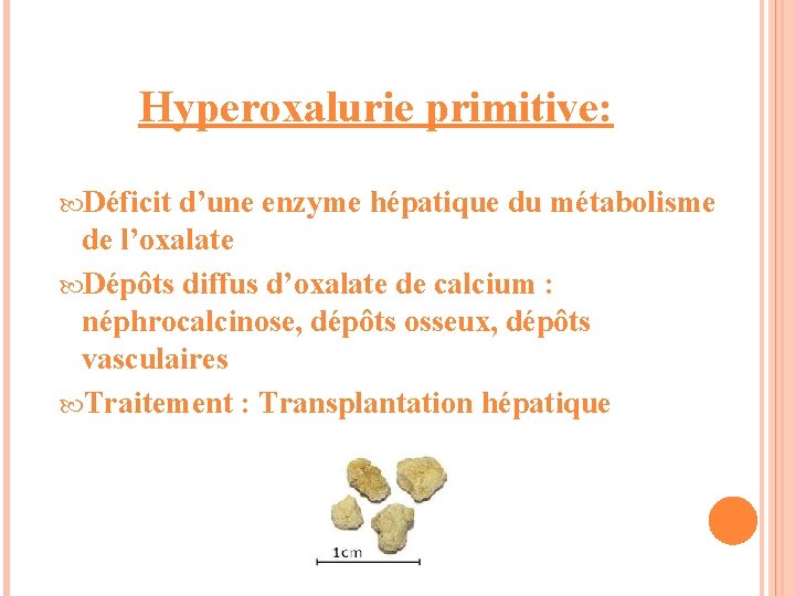 Hyperoxalurie primitive: Déficit d’une enzyme hépatique du métabolisme de l’oxalate Dépôts diffus d’oxalate de