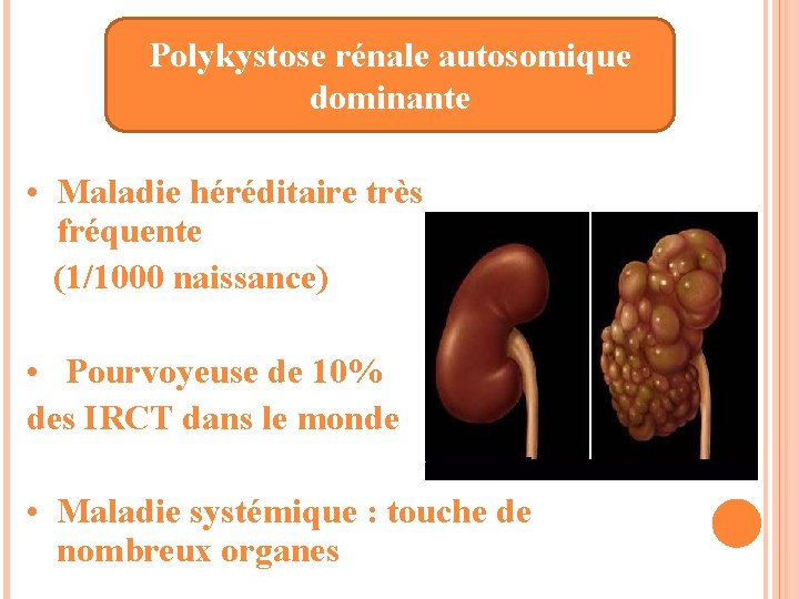 Polykystose rénale autosomique dominante • Maladie héréditaire très fréquente (1/1000 naissance) • Pourvoyeuse de