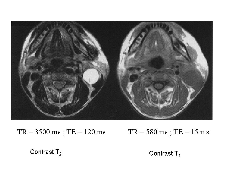 TR = 3500 ms ; TE = 120 ms Contrast T 2 TR = TR = 3500 ms ; TE = 120 ms Contrast T 2 TR =