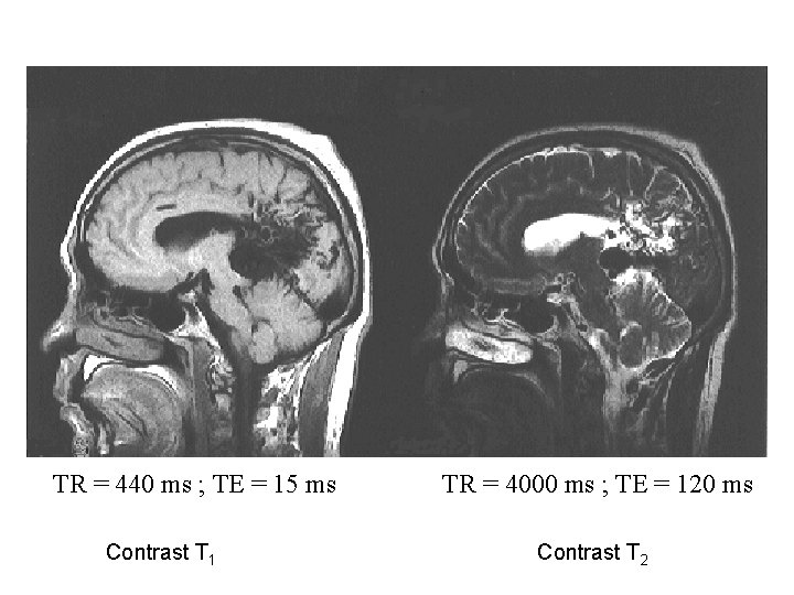 TR = 440 ms ; TE = 15 ms Contrast T 1 TR = TR = 440 ms ; TE = 15 ms Contrast T 1 TR =