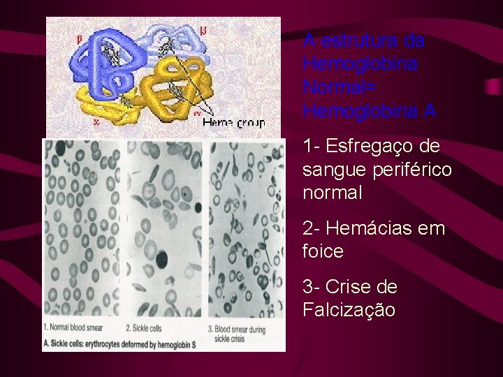 A estrutura da Hemoglobina Normal= Hemoglobina A 1 - Esfregaço de sangue periférico normal