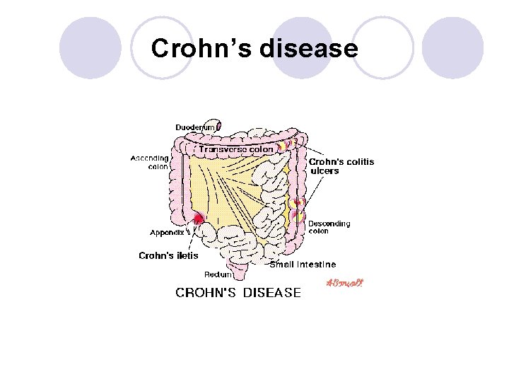 Crohn’s disease Crohn’s disease