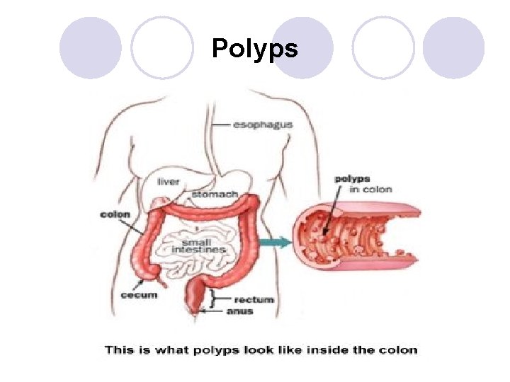 Polyps 