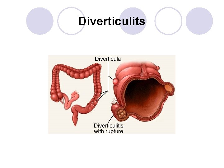 Diverticulits 