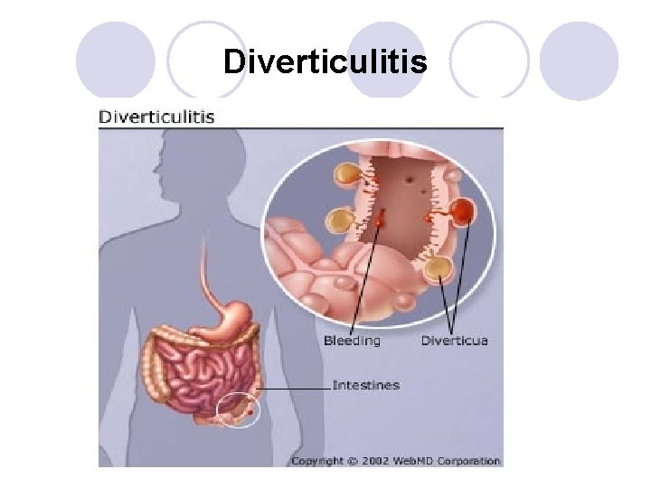 Diverticulitis Diverticulitis