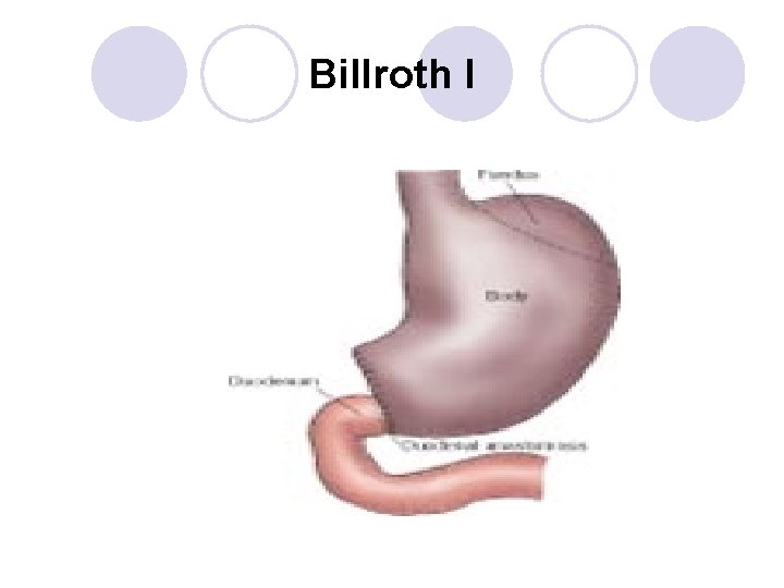 Billroth I 