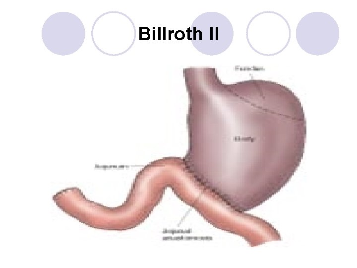 Billroth II Billroth II