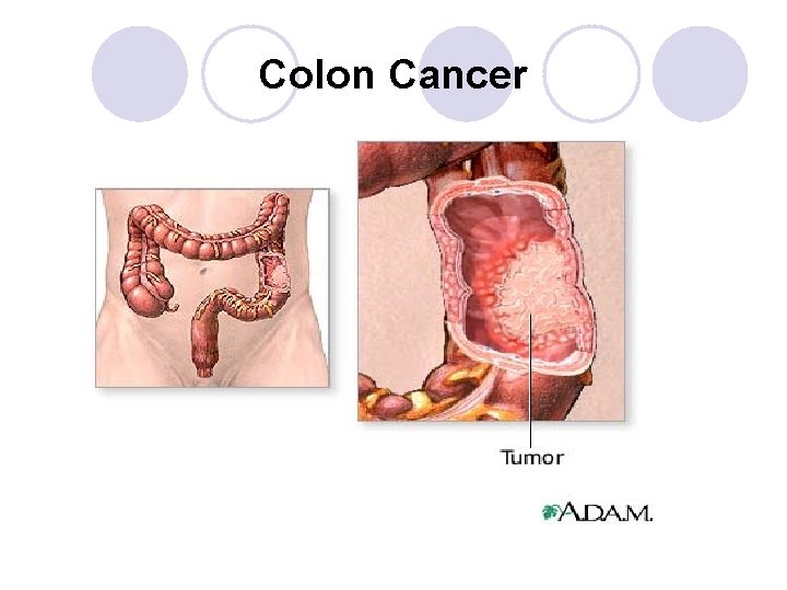 Colon Cancer 