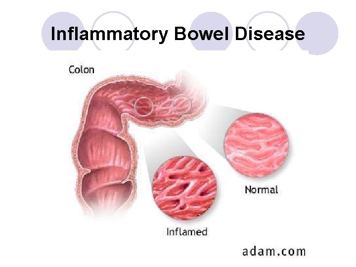 Inflammatory Bowel Disease Inflammatory Bowel Disease