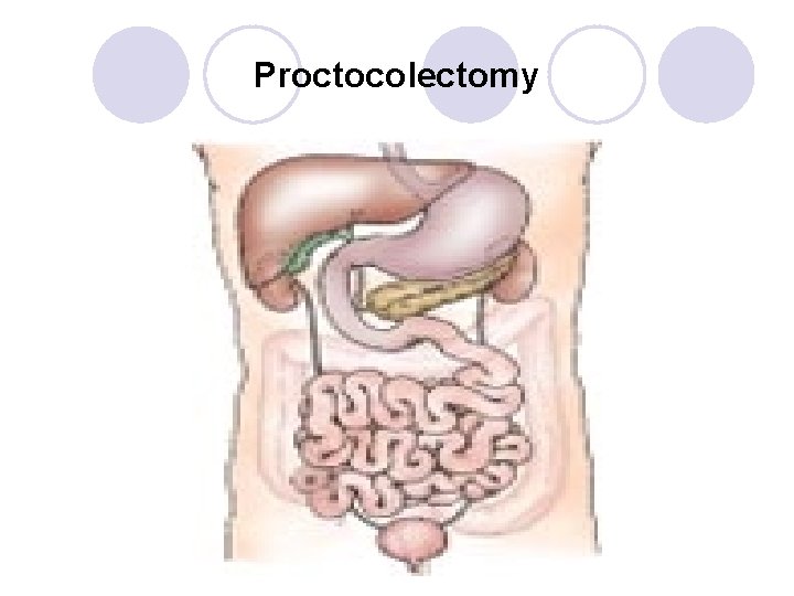 Proctocolectomy Proctocolectomy