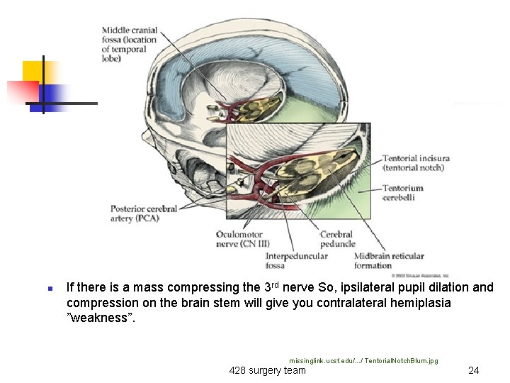 n If there is a mass compressing the 3 rd nerve So, ipsilateral pupil