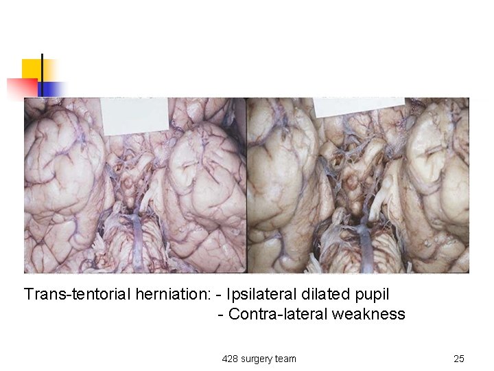 Trans-tentorial herniation: - Ipsilateral dilated pupil - Contra-lateral weakness 428 surgery team 25 