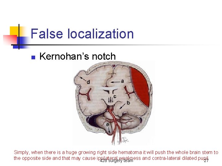 False localization n Kernohan’s notch Simply, when there is a huge growing right side