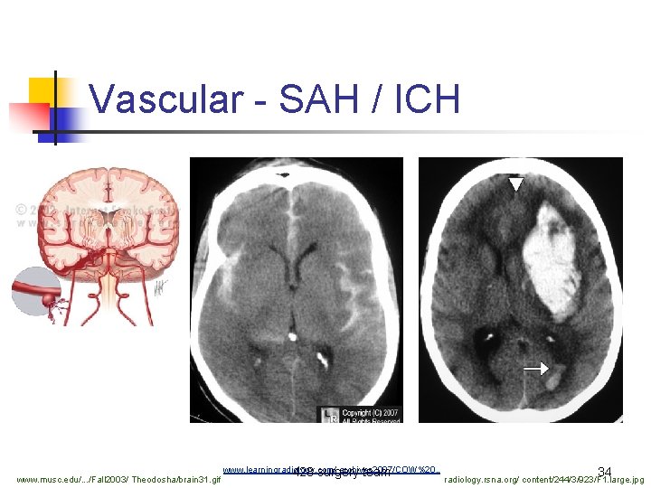 Vascular - SAH / ICH www. musc. edu/. . . /Fall 2003/ Theodosha/brain 31.