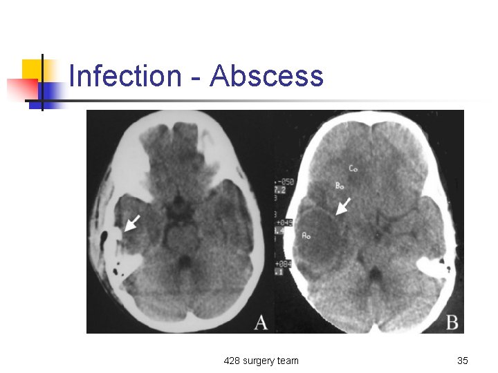 Infection - Abscess 428 surgery team 35 
