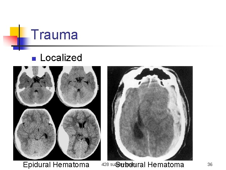 Trauma n Localized Epidural Hematoma Subdural Hematoma 428 surgery team 36 