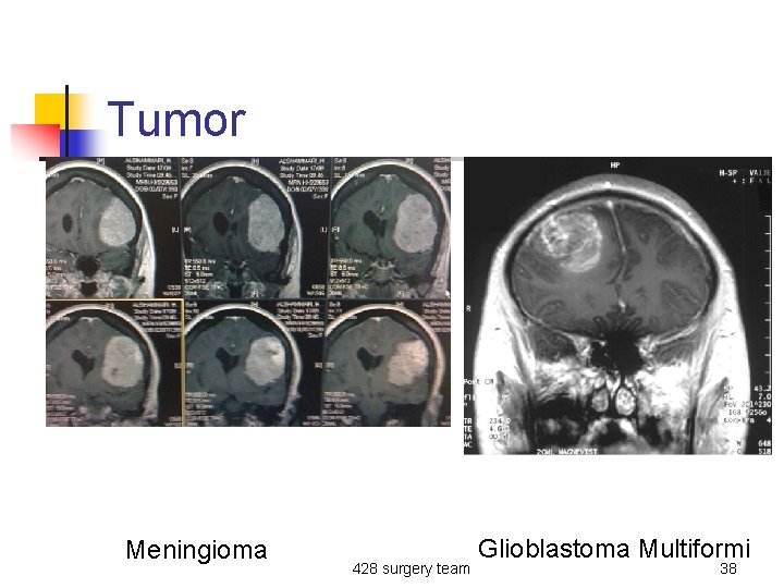 Tumor Meningioma 428 surgery team Glioblastoma Multiformi 38 