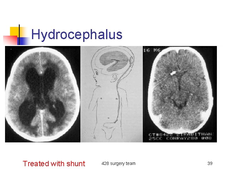 Hydrocephalus Treated with shunt 428 surgery team 39 