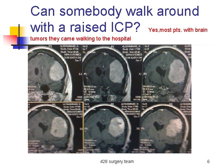 Can somebody walk around with a raised ICP? Yes, most pts. with brain tumors