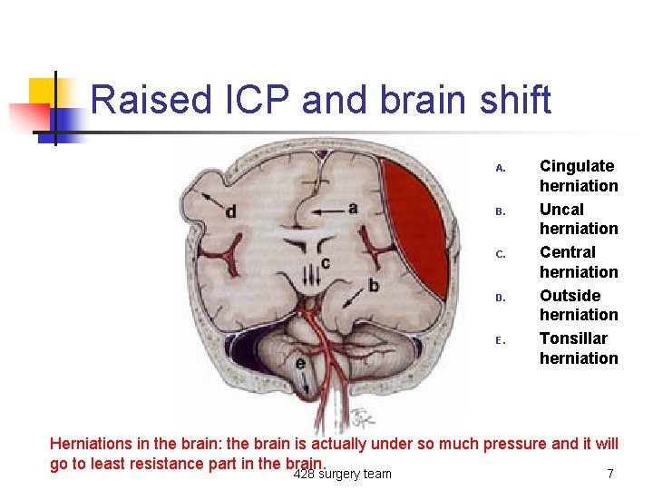 Raised ICP and brain shift A. B. C. D. E. Cingulate herniation Uncal herniation