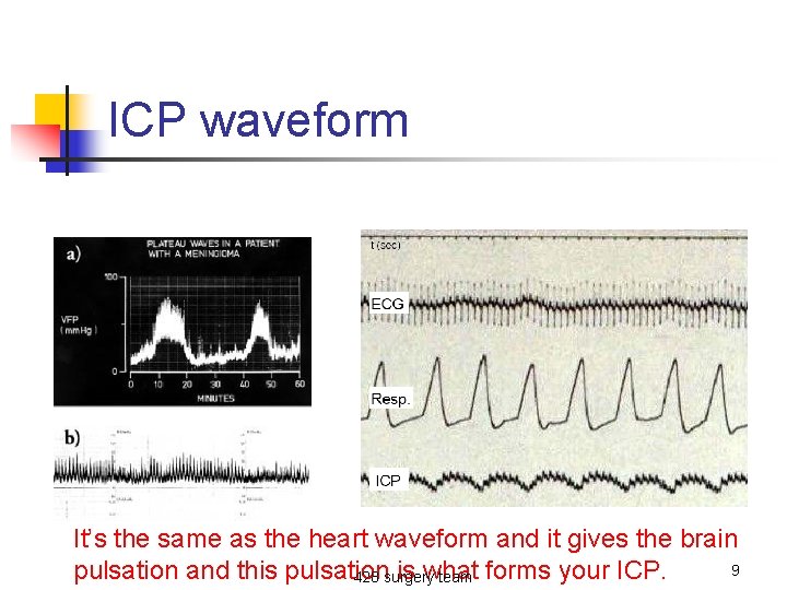 ICP waveform It’s the same as the heart waveform and it gives the brain