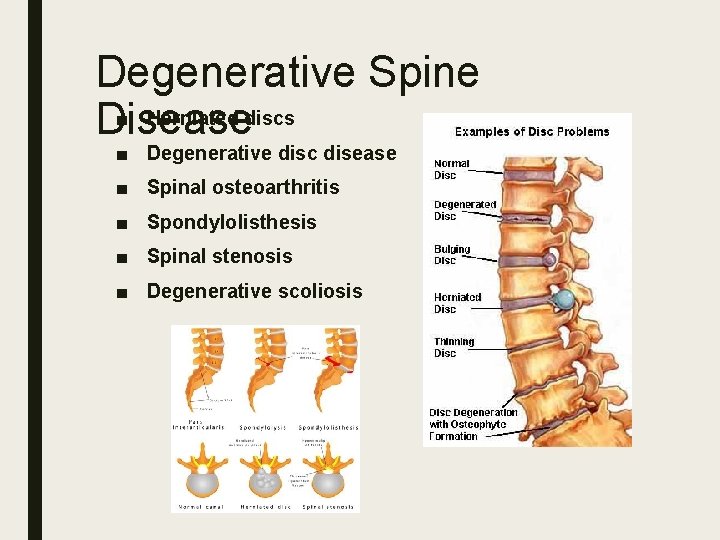 Degenerative Spine ■ Herniated discs Disease ■ Degenerative disc disease ■ Spinal osteoarthritis ■