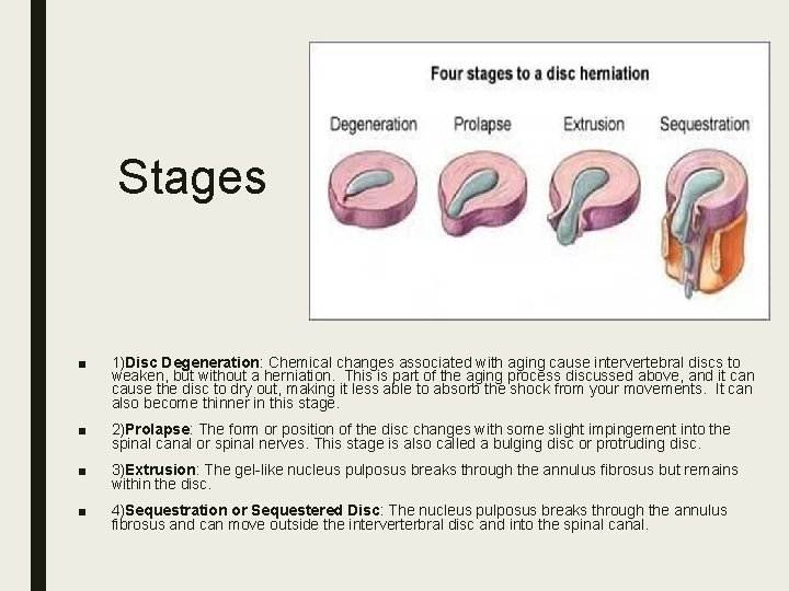 Stages ■ 1)Disc Degeneration: Chemical changes associated with aging cause intervertebral discs to weaken,