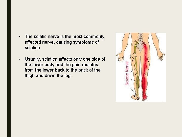  • The sciatic nerve is the most commonly affected nerve, causing symptoms of