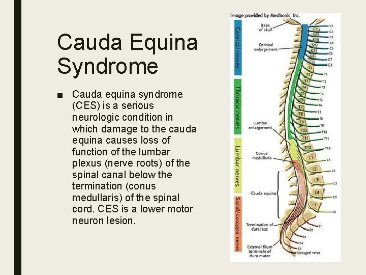 Cauda Equina Syndrome ■ Cauda equina syndrome (CES) is a serious neurologic condition in