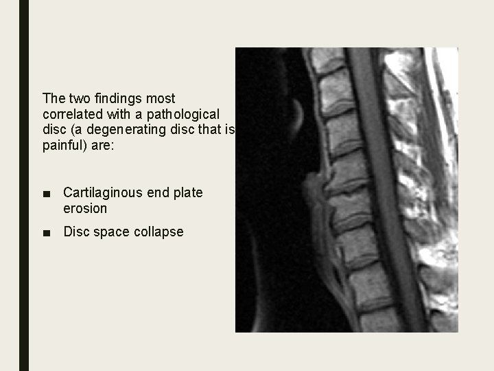 The two findings most correlated with a pathological disc (a degenerating disc that is