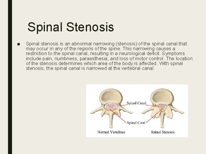 Spinal Stenosis ■ Spinal stenosis is an abnormal narrowing (stenosis) of the spinal canal