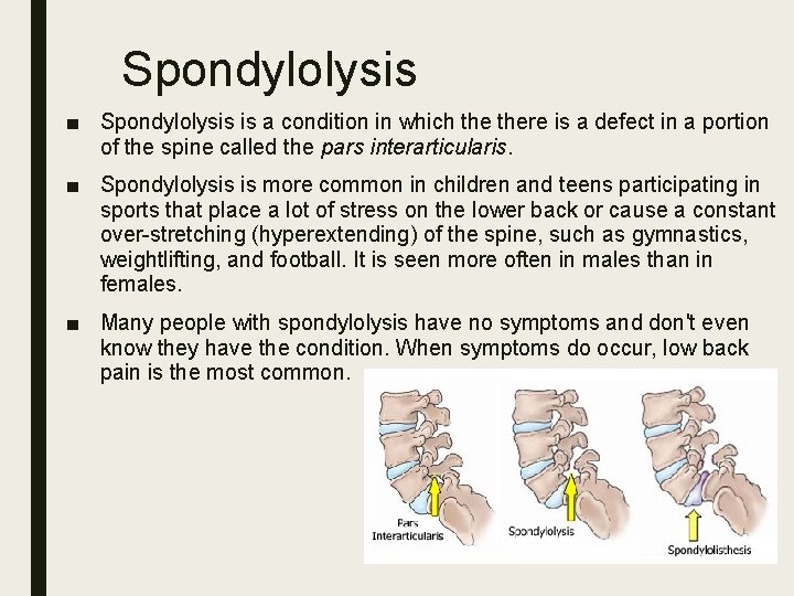Spondylolysis ■ Spondylolysis is a condition in which there is a defect in a