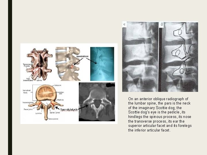 On an anterior oblique radiograph of the lumbar spine, the pars is the neck