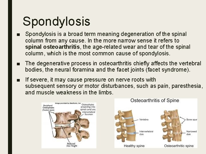 Spondylosis ■ Spondylosis is a broad term meaning degeneration of the spinal column from