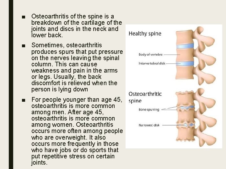 ■ Osteoarthritis of the spine is a breakdown of the cartilage of the joints