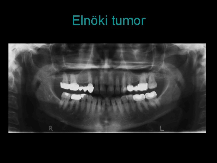 Elnöki tumor 