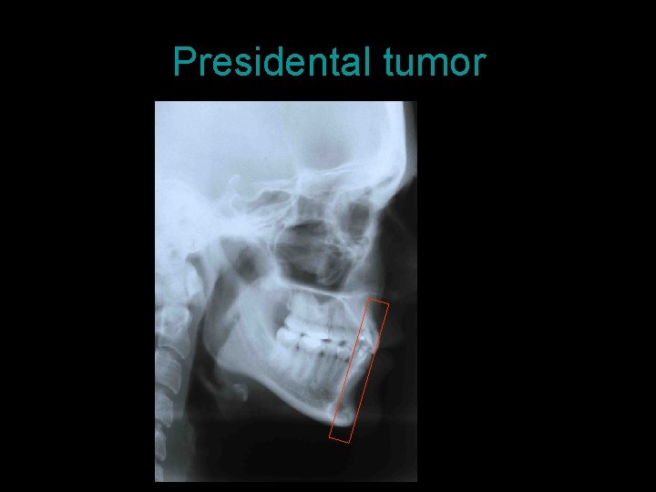 Presidental tumor 