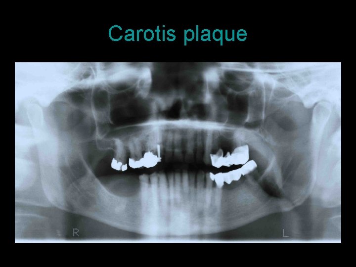 Carotis plaque 