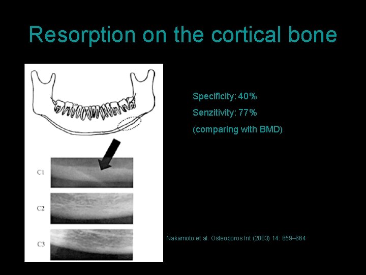 Resorption on the cortical bone Specificity: 40% Senzitivity: 77% (comparing with BMD) Nakamoto et